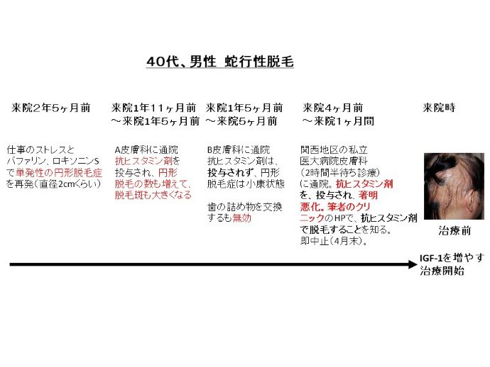 円形脱毛症　病院